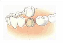 Coller une Dent, Couronne, Bridge avec du Ciment Dentaire (MEDIDENT  RESCELLEMENT) 