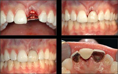 Remplacement dents manquantes dentier