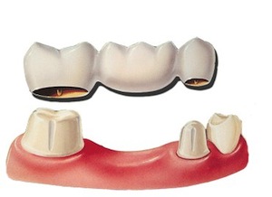Colle de ciment dentaire permanente extra forte pour dents