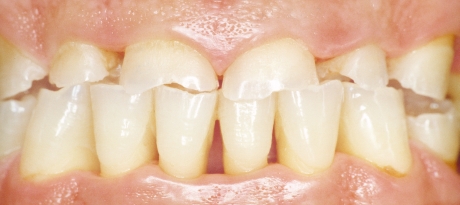 Protège dents pour enfant jusqu'à 12 ans pour sports de contact adaptable à  la mâchoire.
