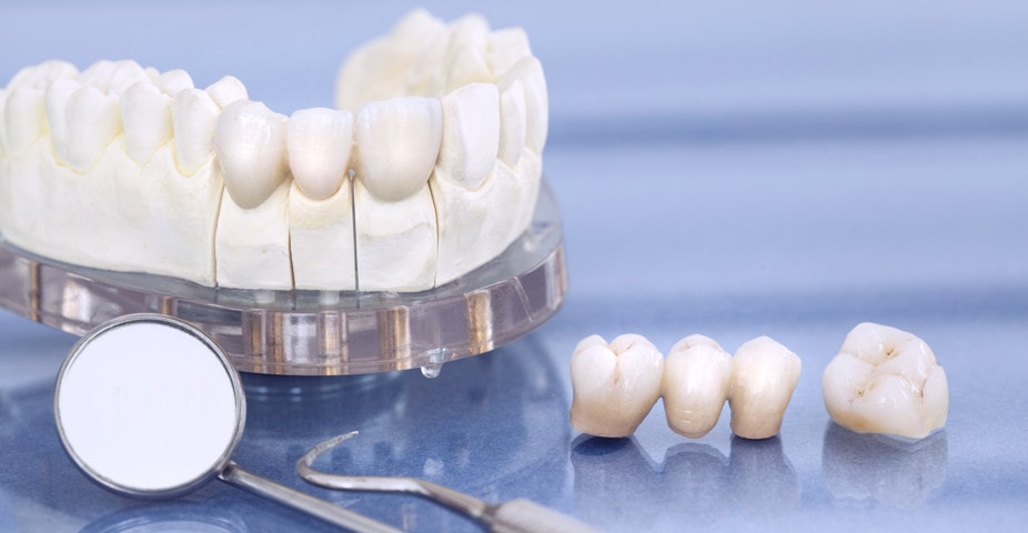 Couronnes dentaires: les explications simples des dentistes Vertuo