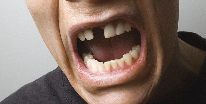 Faux Dentier Dent Provisoire Fausse Dent Dentier Amovible Haut Et Bas Ton  Naturel Facette Prothese Dentaire Fausses Dents Alternatives Au Blanchiment