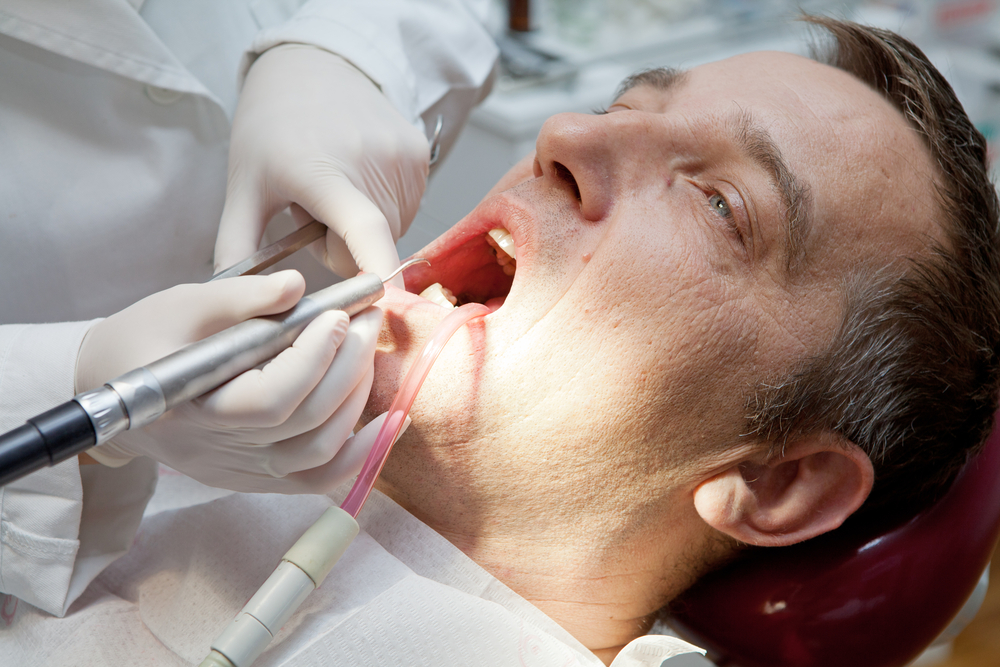 Tartre dentaire : symptômes, cause, comment l'enlever ?