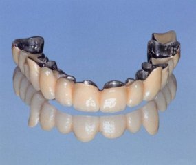 Ciment dentaire : pour fixer de façon durable vos couronnes, bridges